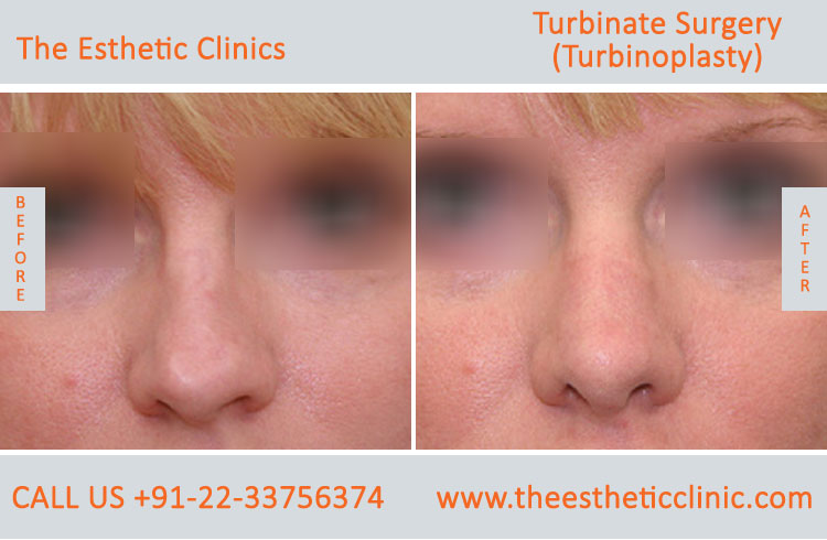 Turbinate Surgery, Turbinoplasty before after photos in mumbai india (3)